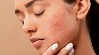 Natural Ways to Get Rid of Pimples as Fast as Possible